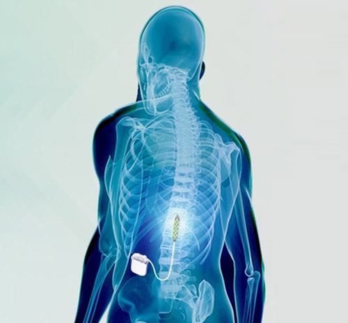 epidural-stimulation-know-about-spinal-cord-injury