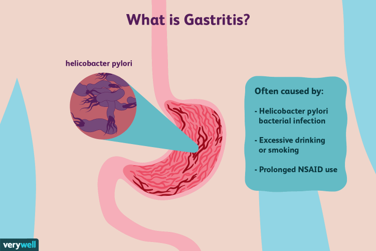 What is GastritisSymptoms, Causes, Treatment, Gastritis Diet & Remedies.