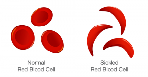 sickle cell anemia