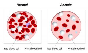 sickle cell anemia