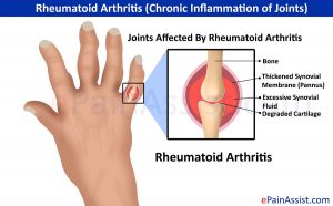   rheumatoid arthritis 