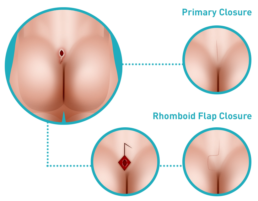  What is a Sacral Dimple