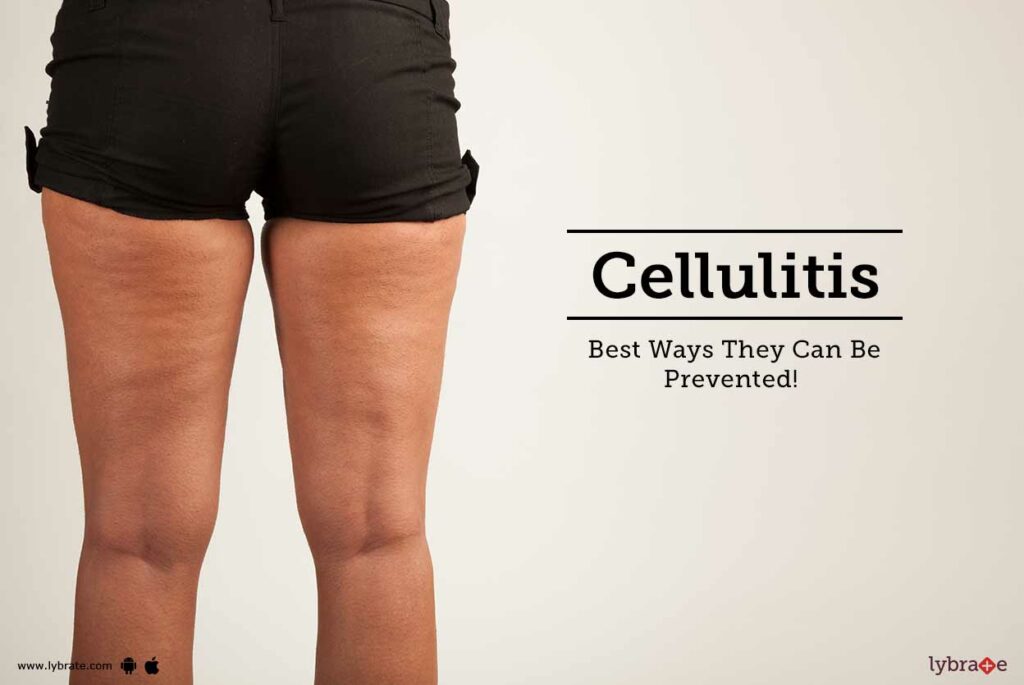 What is Cellulitis? Its Causes, Symptoms, Treatment Bee Healthy
