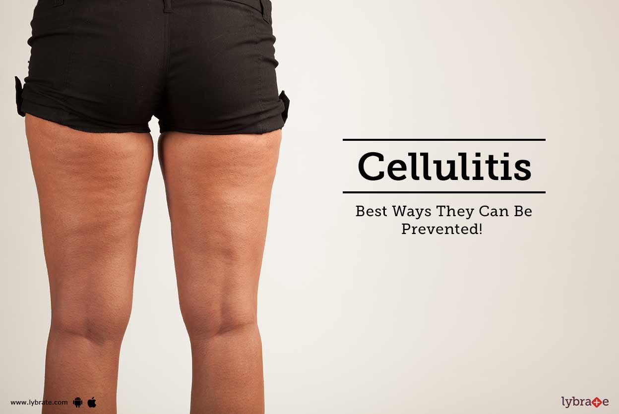 What is Cellulitis?