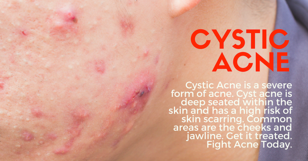 How To Get Rid of Cystic Acne Best Health Canada