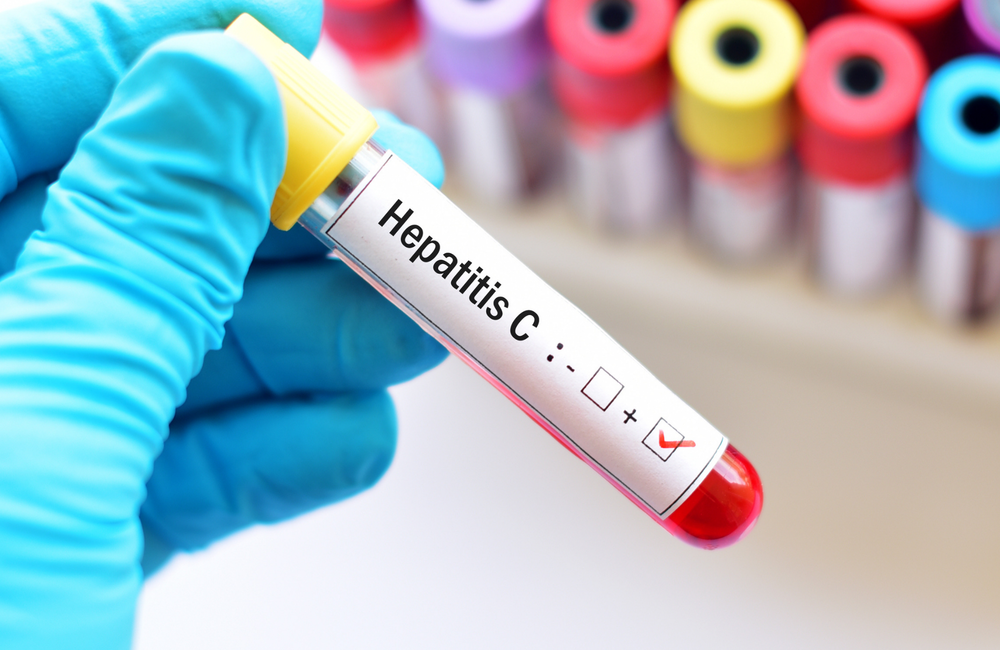 Hepatitis C