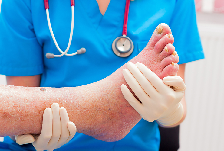 What is Cellulitis? 