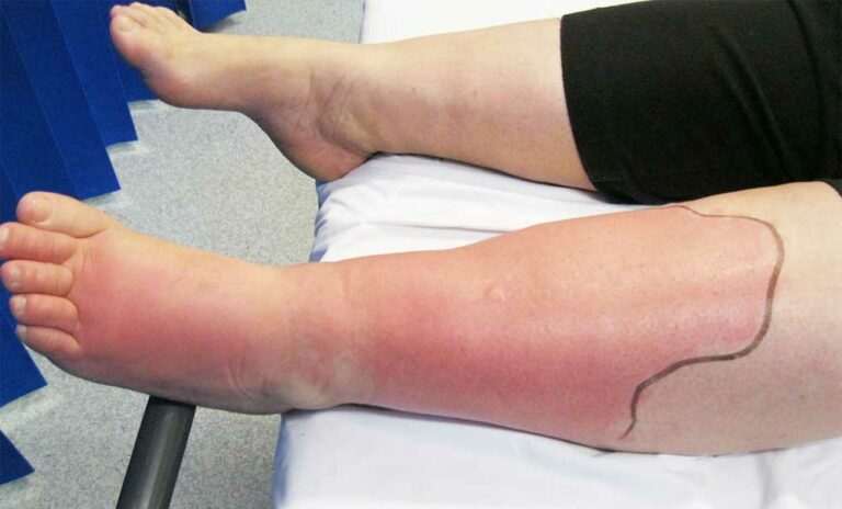 What Is Cellulitis Its Causes Symptoms Treatment Bee Healthy