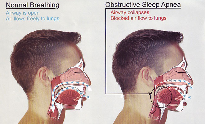 Sleep apnea