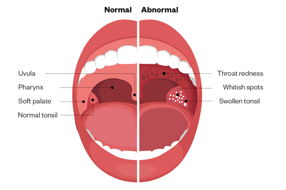 symptoms of strep throat