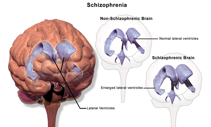 Schizophrenia