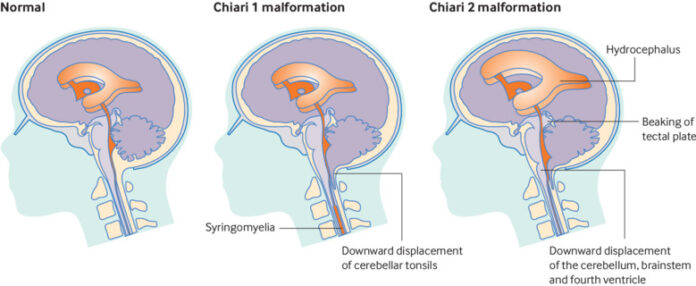 Chiari malformations