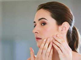 Your Acne May Be Flaring Up